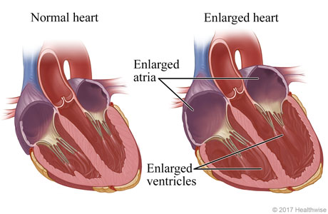 HVI Dilated Cardiomyopathy